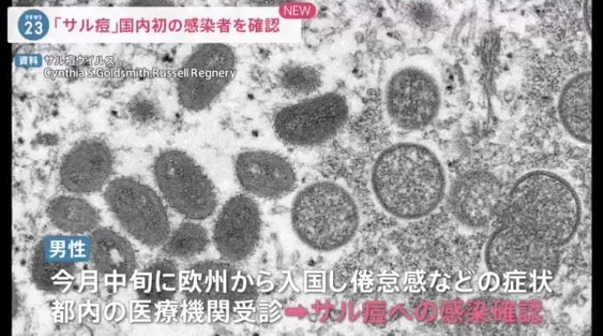 First case of monkeypox, confirmed in Japan! (TBS)